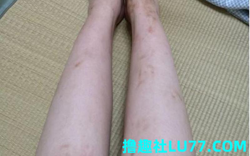 梦见疤 梦见疤