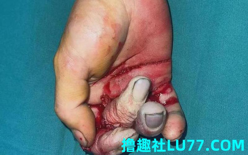 梦见多指断