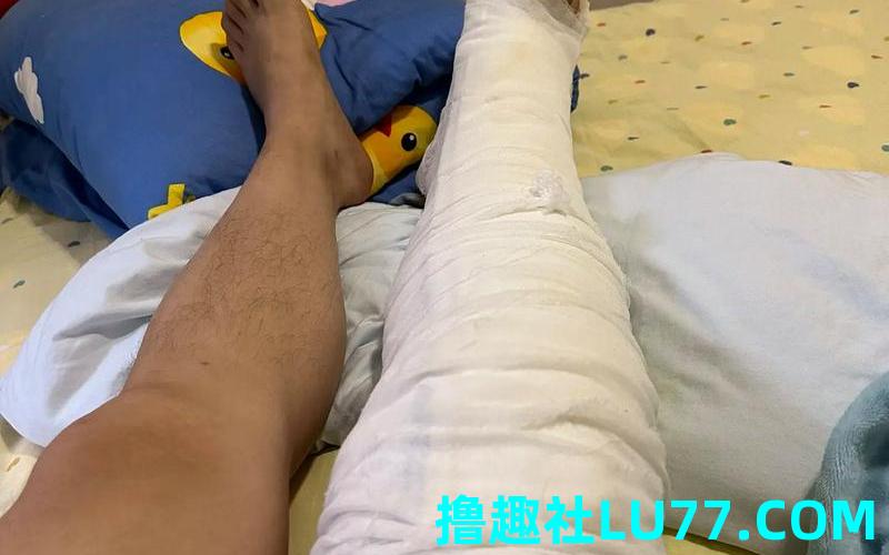 梦见腿骨折