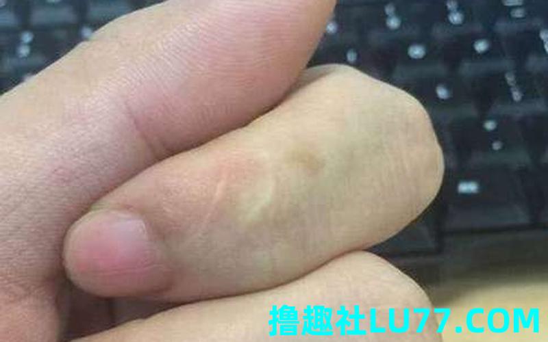 梦见我伤口 梦见我伤口