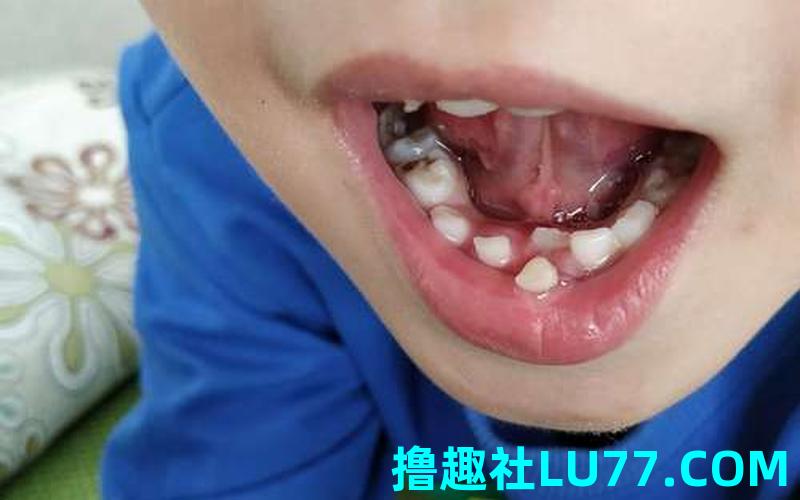 梦见牙齿卡了东西