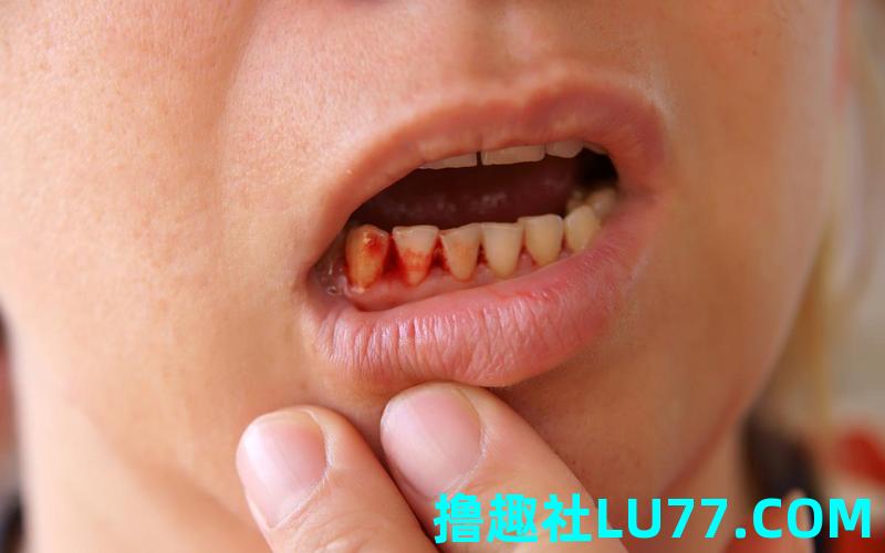 梦见牙齿掉了满嘴是血 梦见牙齿掉了满嘴是血