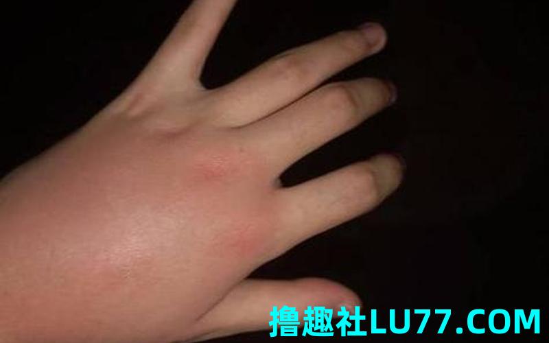 梦见虫子咬别人 梦见虫子咬别人