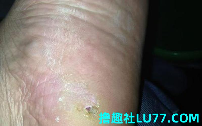 梦见脚后跟有个洞 梦见脚后跟有个洞