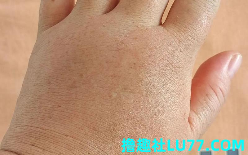 梦见生病手肿 梦见生病手肿