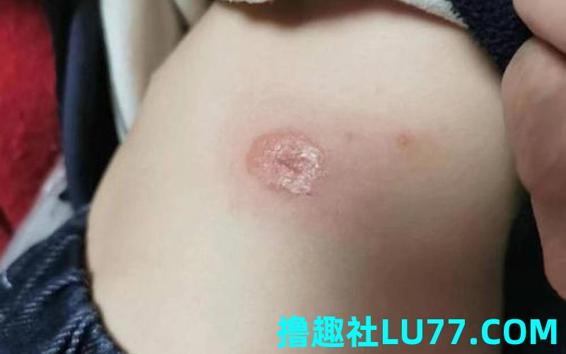 梦见身上有脓包破了