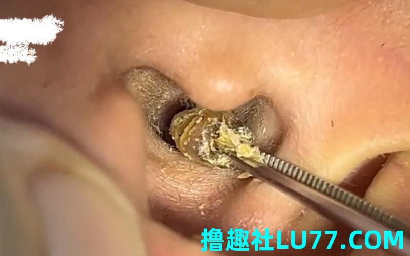 做梦梦见掏耳屎