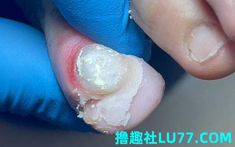 梦见铁藜扎脚