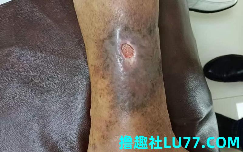 梦见自己的小腿烂了