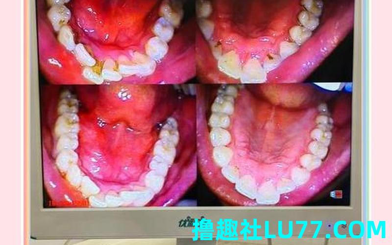 梦见牙齿有个洞