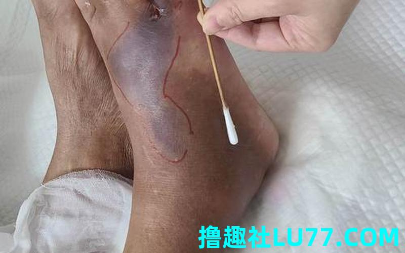 梦见被眼镜蛇咬伤