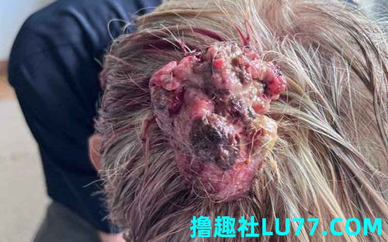 梦见头上生蛆了