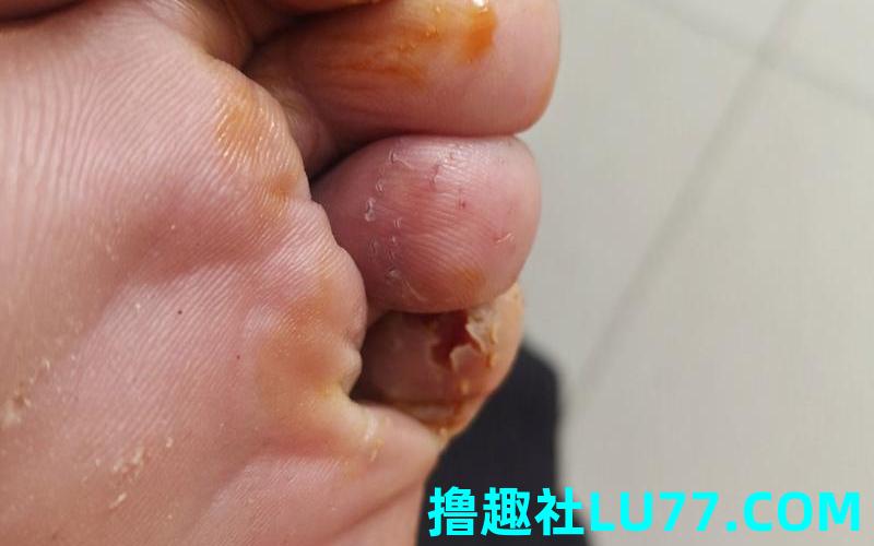 梦见被老鼠咬到脚了