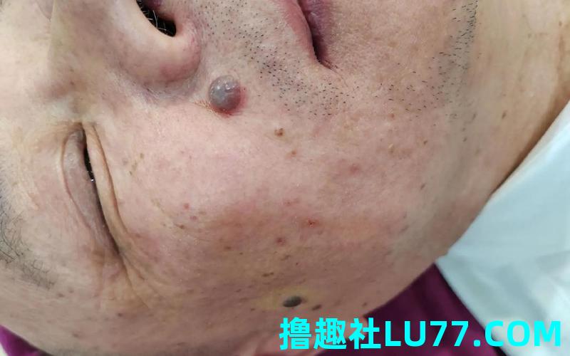 梦见长肉色痣 梦见长肉色痣