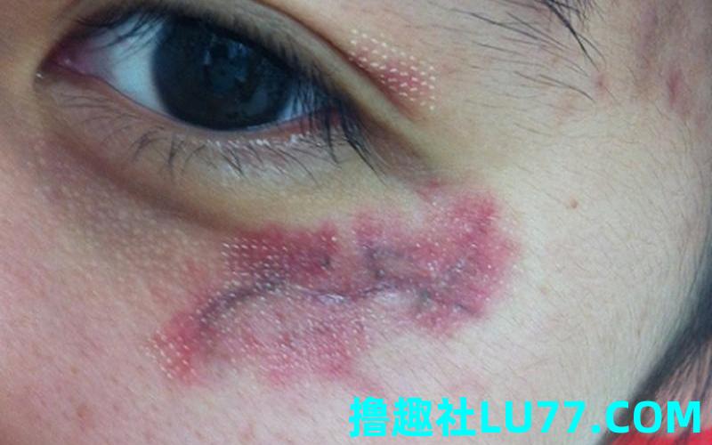 梦见脸上有伤疤 梦见脸上有伤疤