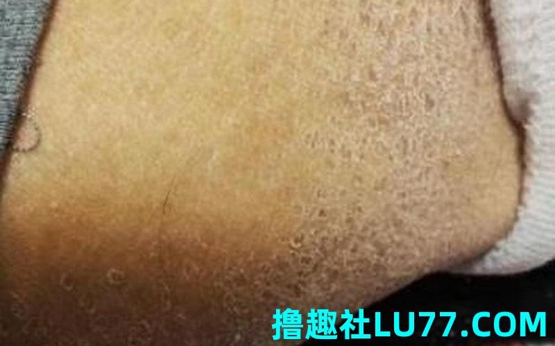 梦见自己身上掉皮