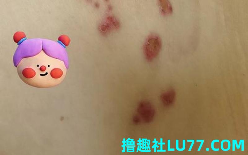 梦见屁股上长疙瘩