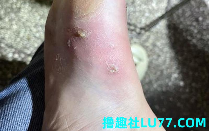 梦见脚长疮 梦见脚长疮