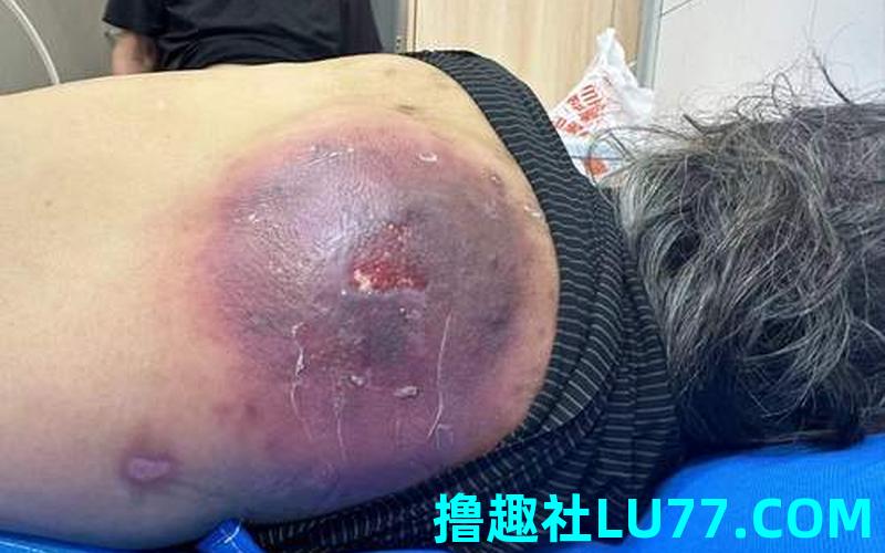 梦见长疔疮