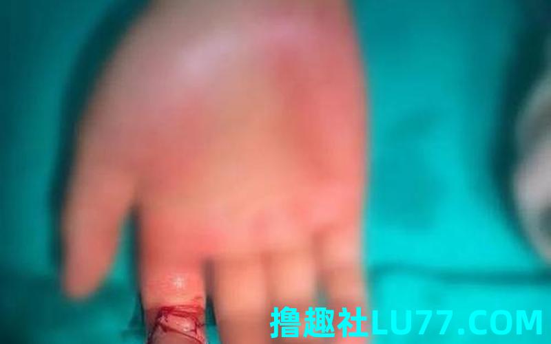 梦见自己右手断了