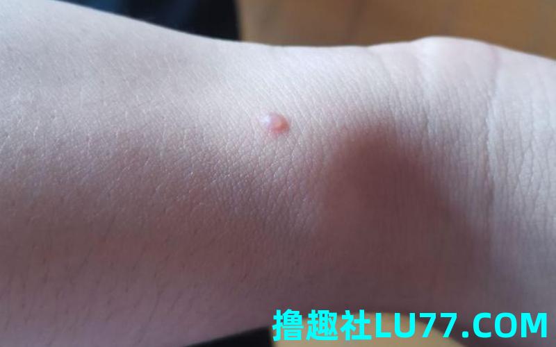 梦见胳膊长水泡