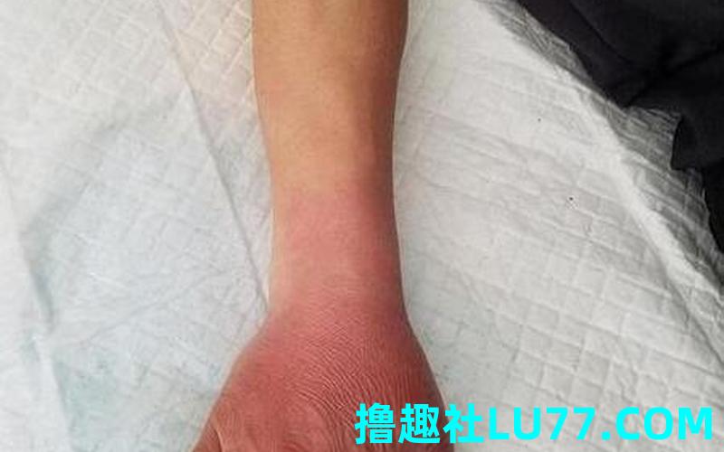 梦见被眼镜蛇咬手