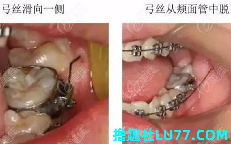 梦见门牙套掉了