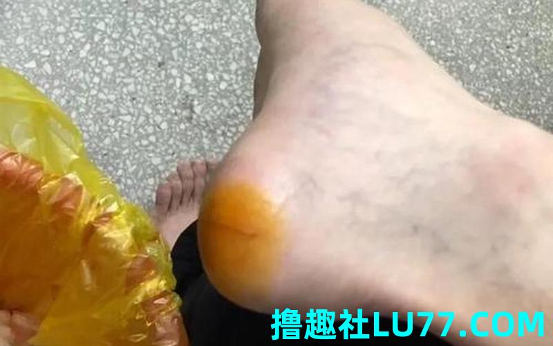 梦见脚被玻璃扎