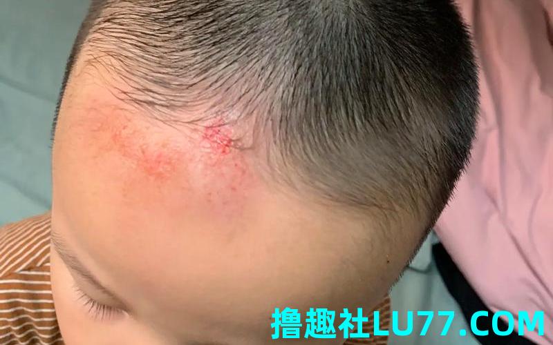 梦见老公头部受伤 梦见老公头部受伤