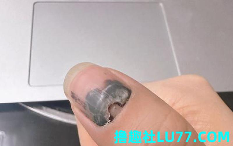 梦见掉指甲 梦见掉指甲