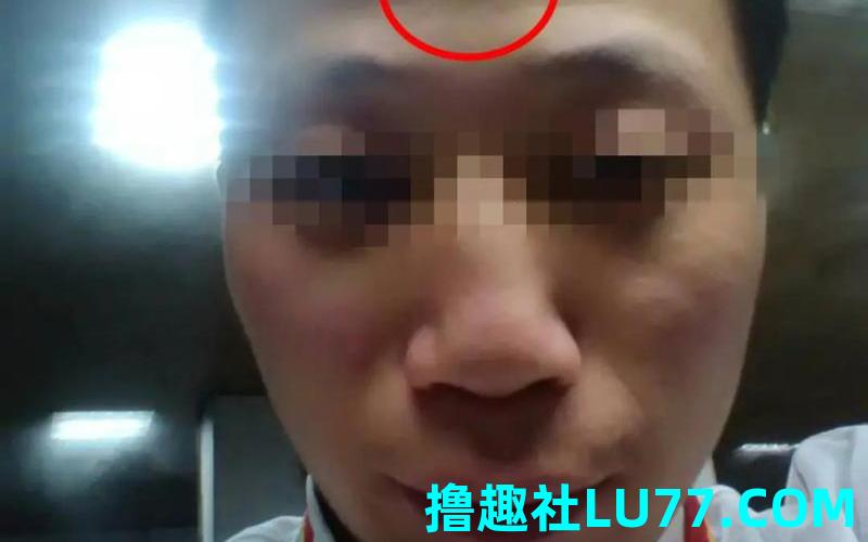 梦见额头有个洞