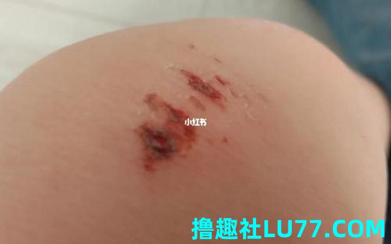 梦见磕破退 梦见磕破退