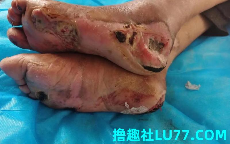 梦见足上生蛆