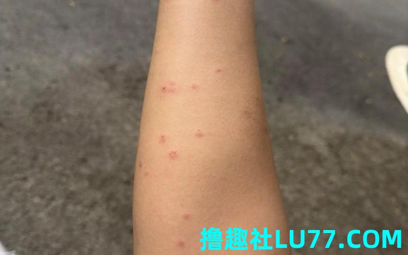 梦见黑蚊叮咬
