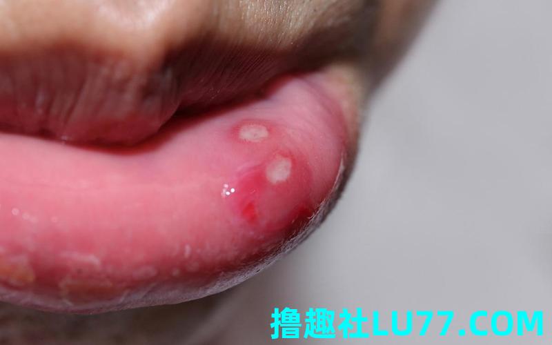 梦见生口疮