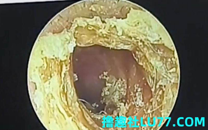 梦见的耳屎 梦见的耳屎