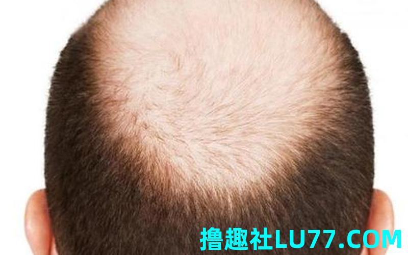 梦见自己掉了头发