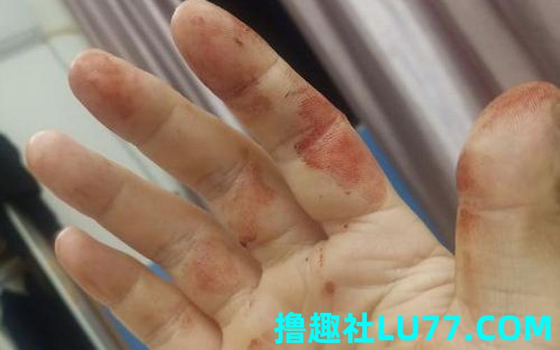 梦见被老鼠咬手背