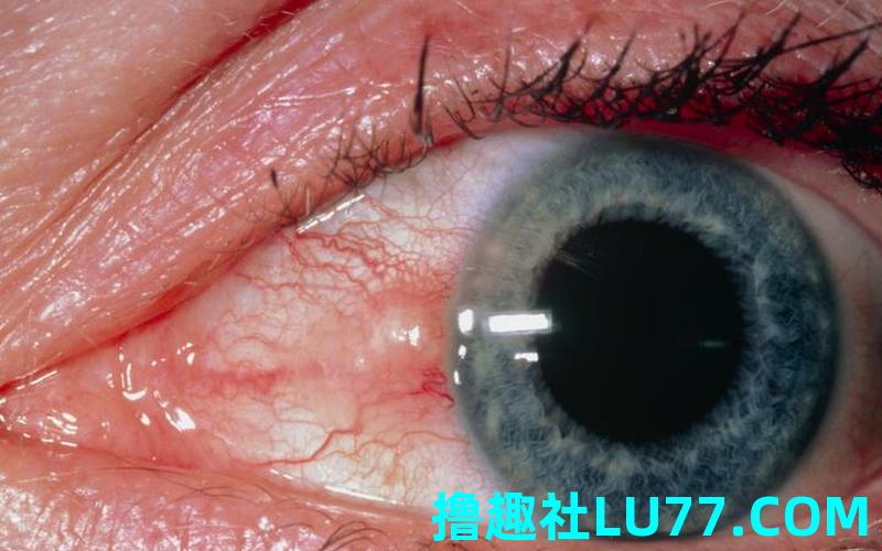 梦见眼尾裂开