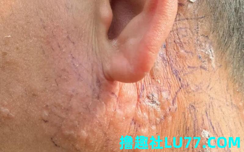 梦见脸上起泡 梦见脸上起泡