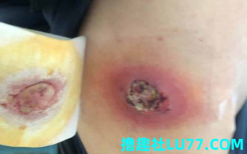 梦见痈 梦见痈