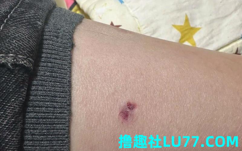 梦见狗咬自己但没出血了