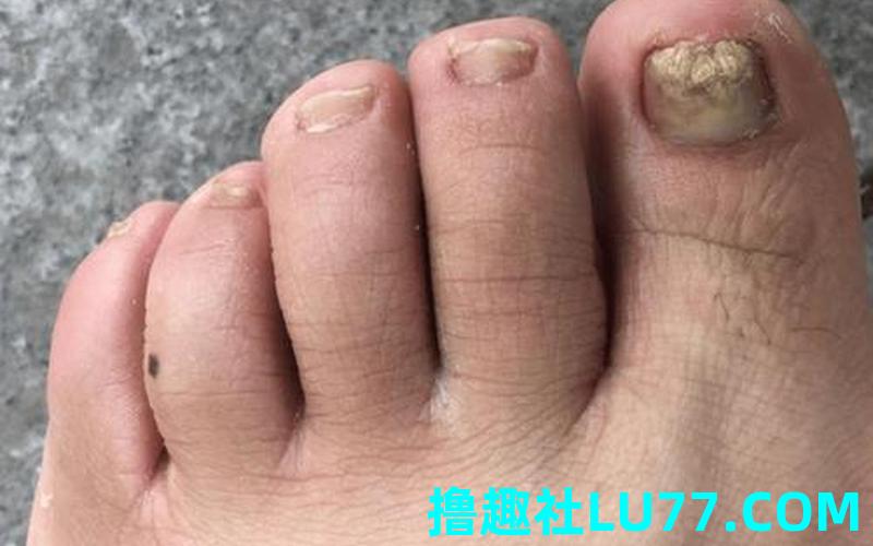 梦见长灰指甲