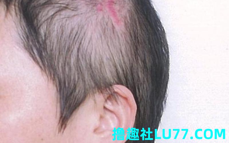 梦见头上有伤口