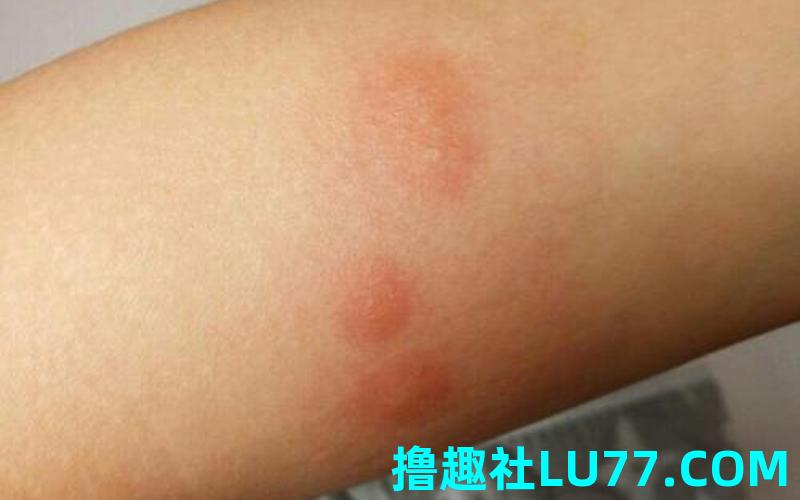 梦见胳膊被虫子咬