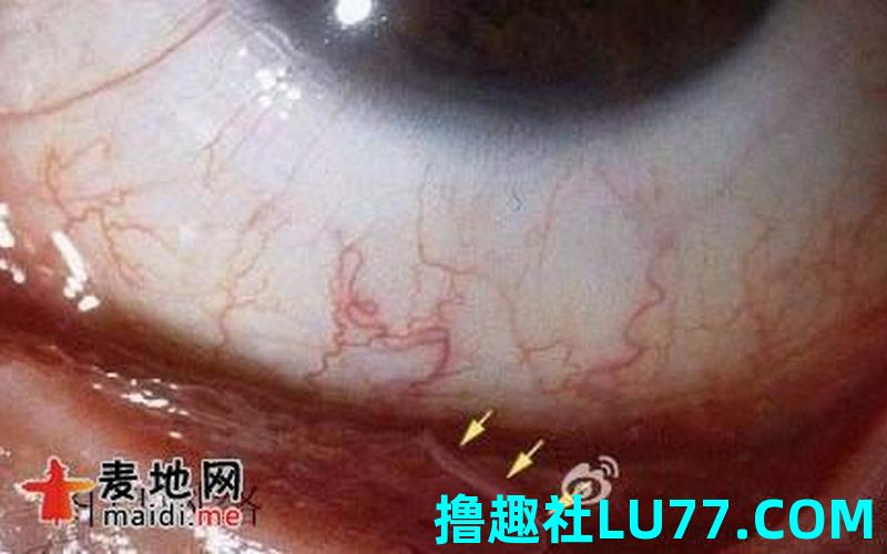 梦见眼里有寄生虫 梦见眼里有寄生虫
