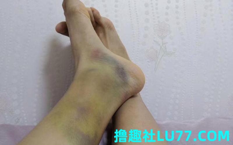 梦见腿有血