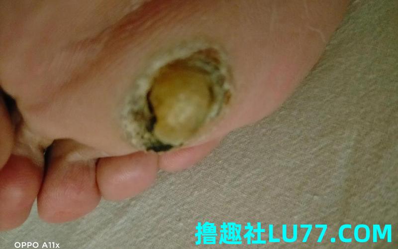 梦见脚底长钉