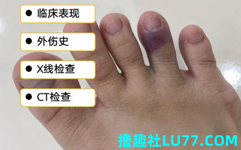 梦见左脚断了是什么意思
