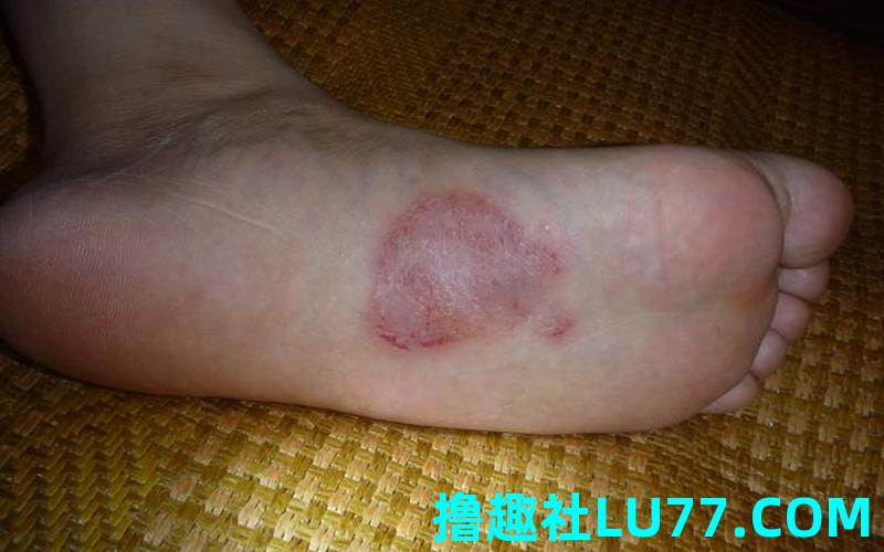 梦见脚底破了